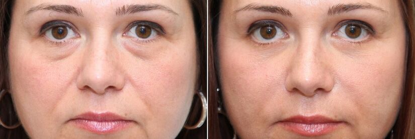 Blefaroplasztika előtt és után - a szem alatti zsírszövet eltávolítása és a bőr feszesítése